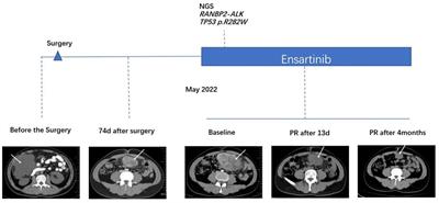 Case report: Epithelioid inflammatory myofibroblastic sarcoma treated with an ALK TKI ensartinib